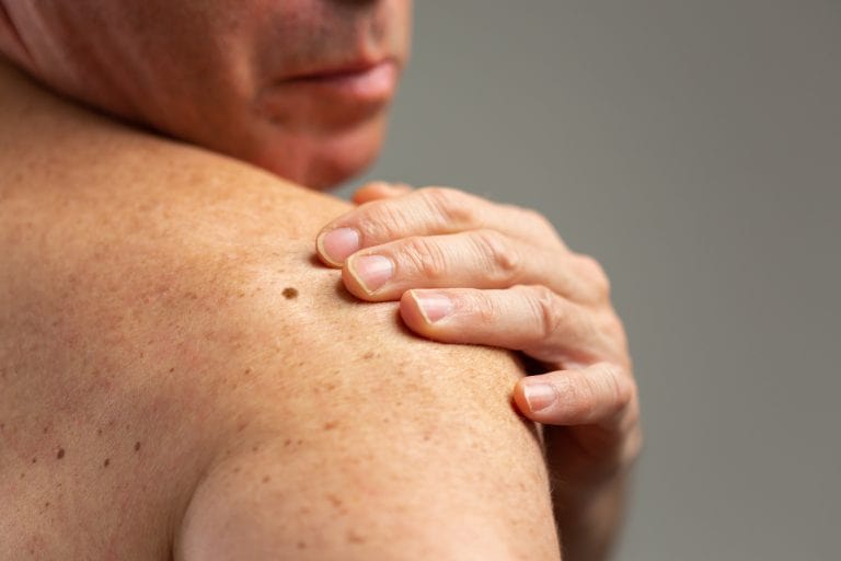 Skin cancer rates on a rise in Belgium