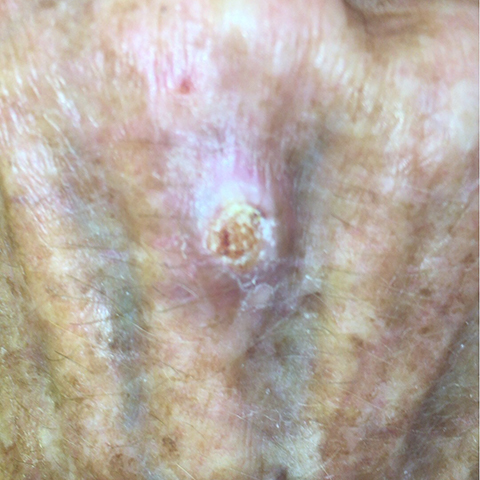 Squamous Cell Carcinoma picture 5