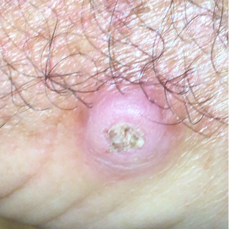 Squamous Cell Carcinoma picture 4