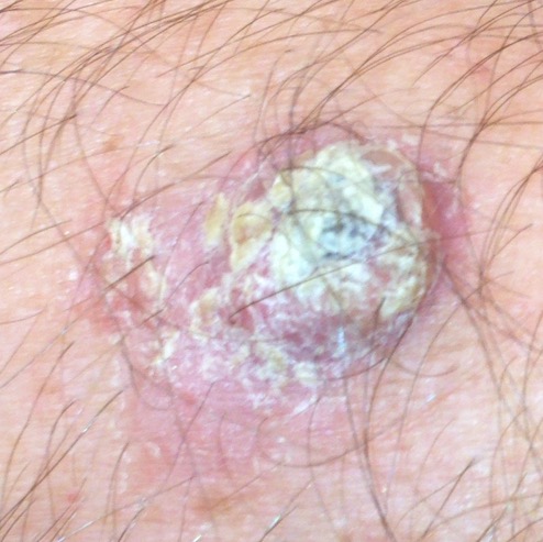 Squamous Cell Carcinoma picture 3