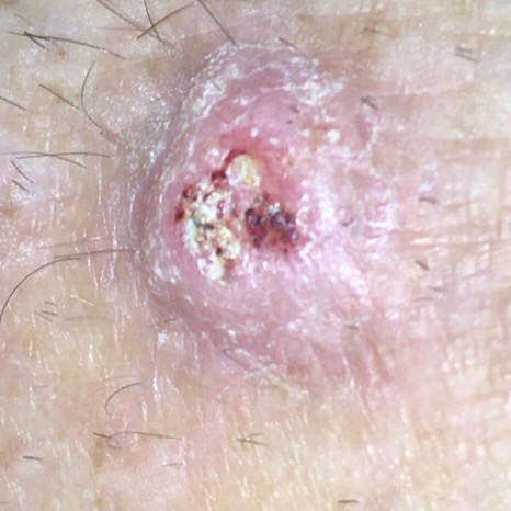 Squamous Cell Carcinoma picture 2