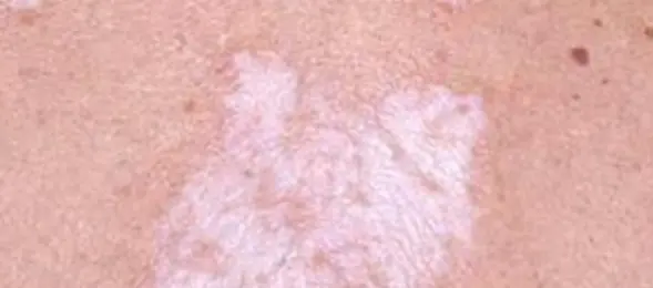 Lichen sclerosus on the skin