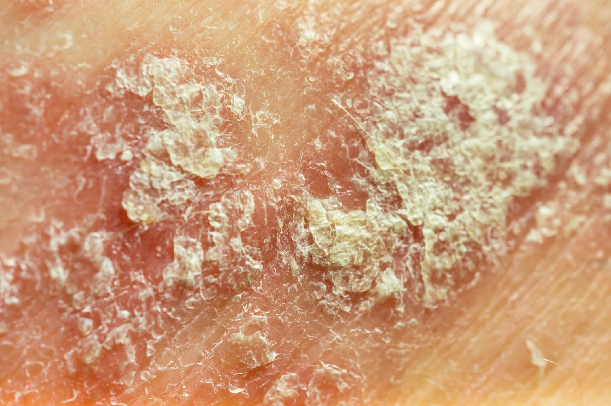Eczema on the skin causing itchy patches with visible scaling and dryness.		