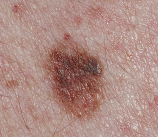 What is skin cancer? Atypical mole with asymmetry, border irregularity, color variations and diameter greater than ¼ inch